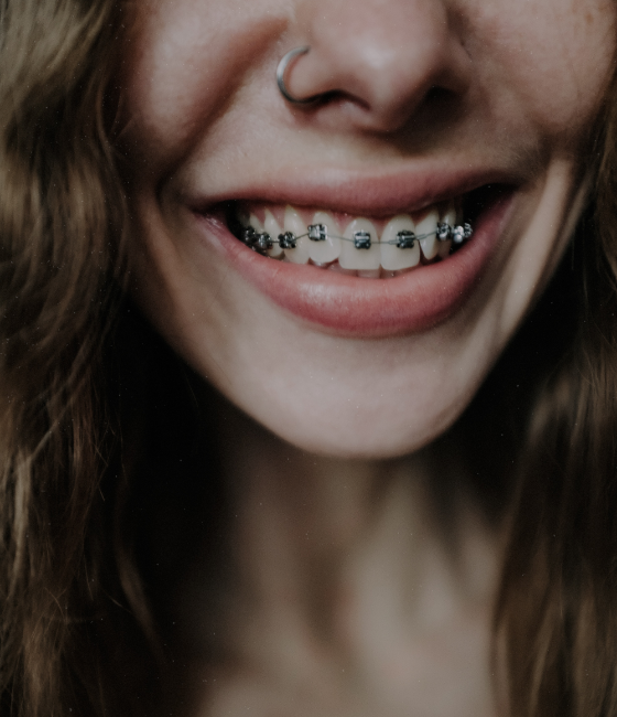 Cabinet d’orthodontie à Villefontaine Orthodontiste à Villefontaine Pose appareils dentaires à Villefontaine Traitement Invisalign à Villefontaine Conseil appareil dentaire Docteur Severine LIONNE